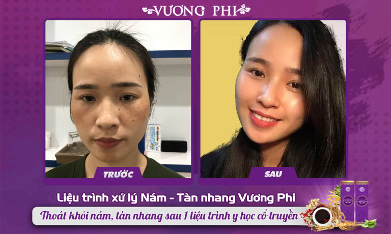 Khách hàng Thanh Thảo cải thiện làn da nám sau khi sử dụng Vương Phi