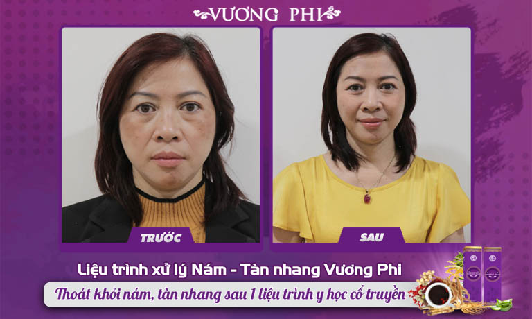 Hình ảnh trước và sau khi dùng của khách hàng