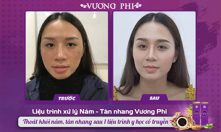 Kết quả xử lý nám tàn nhang của chị Thu Hương