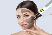 Trị nám sạm tàn nhang bằng laser