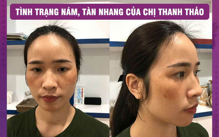 Da mặt của chị Thanh Thảo hỗn hợp cả nám và tàn nhang