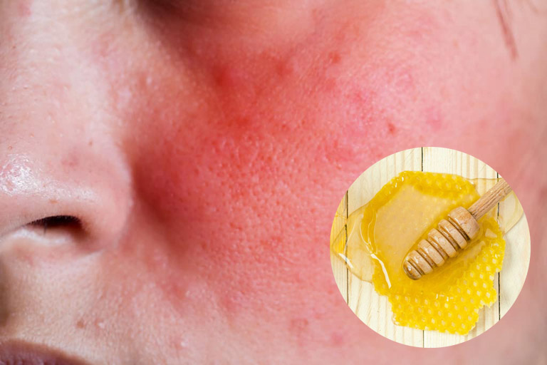 Dùng không đúng cách, da nhạy cảm mật ong có thể gây kích ứng da, mẩn đỏ