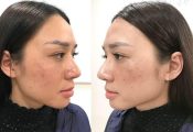 Xử Lý Nám Da Sai Cách, Nám Không Những Không Hết, Làn Da Còn Nhận "Quả Đắng"