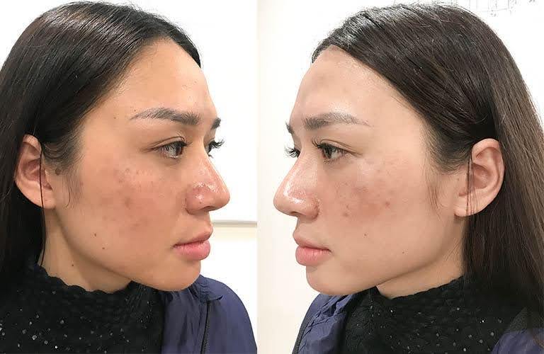 Chị Thu Hương thất bại sau 6 lần laser