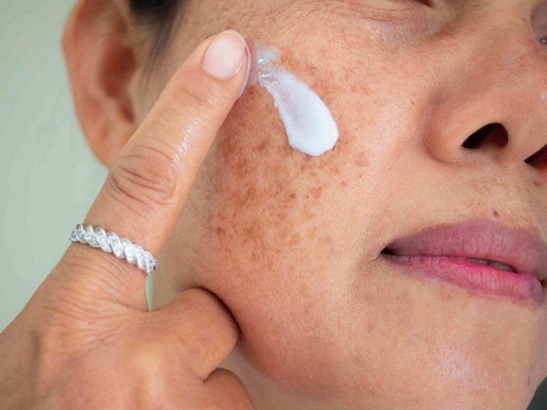 Nhiều chị em xử lý nám tại nhà bằng dược mỹ phẩm như kem bôi, serum,...