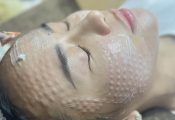 Khắc phục nám da bằng laser, peel, meso có hiệu quả không?