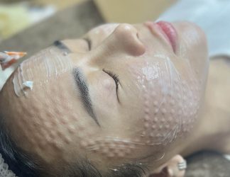 Khắc phục nám da bằng laser, peel, meso có hiệu quả không?