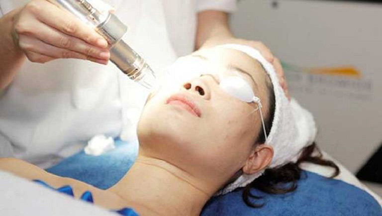 Laser có thể giúp bạn lấy đi sắc tố nám hình thành trên da